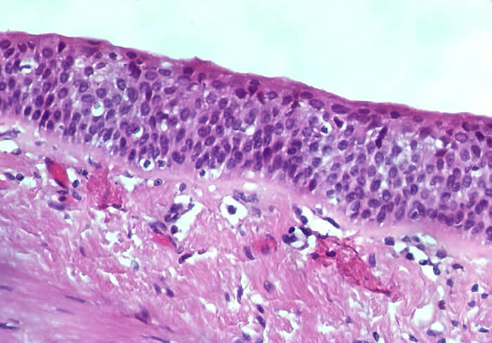 Bronchial Squamous Metaplasia