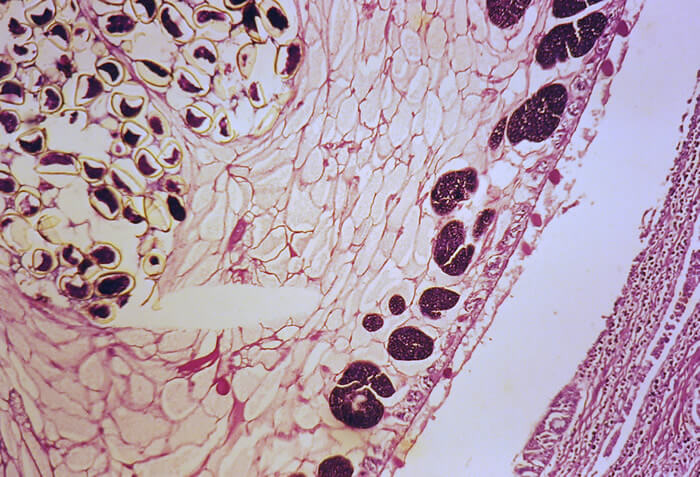 Paragonimiasis